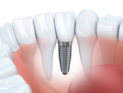 Dental Implant Cohasset